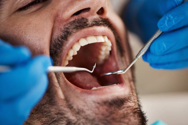 Best Broken or Chipped Tooth Repair in Hidden Meadows, CA